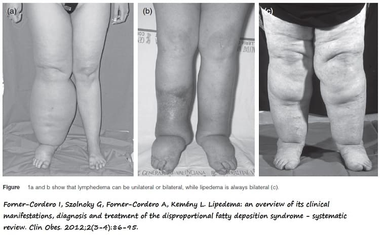 Izda: EEII paciente linfedema unilateral. Centro: EEII paciente linfedema bilateral. Drcha: EEII paciente lipoedema